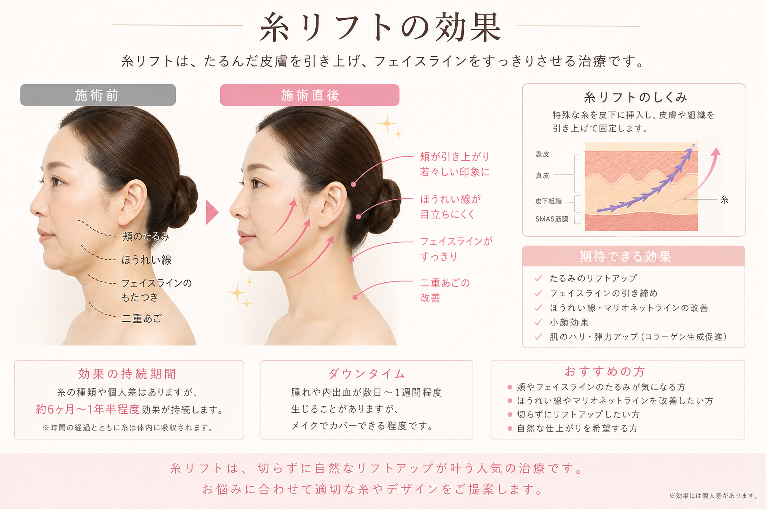 糸リフトの効果と施術ダメージ